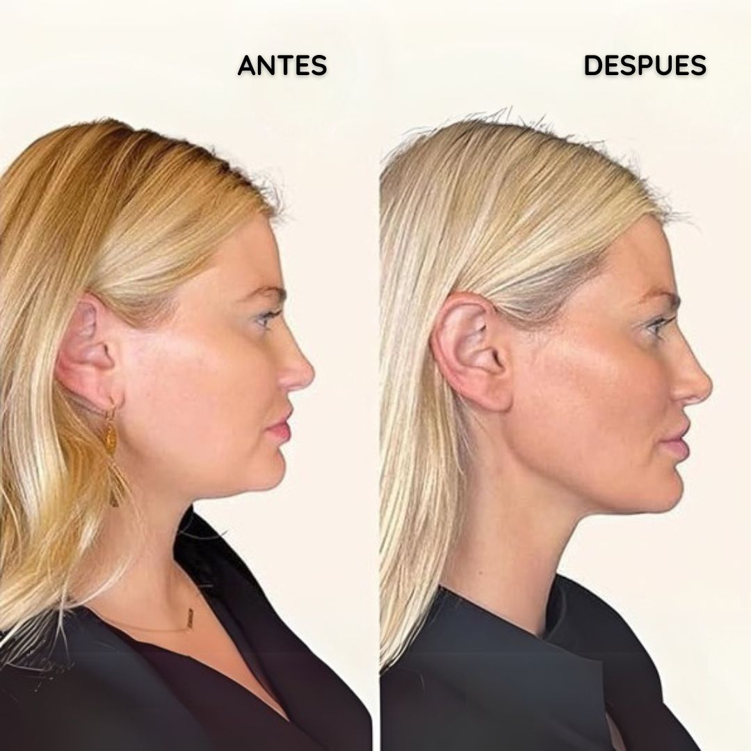MASAJEADOR FACIAL CON MICROCORRIENTE